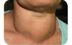 Endocrine system and adolensence a person suffering from goitre