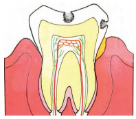 life-process-dental-Tooth-decay-starts-on-the-top-of- caries-large-back-teeth-and-where-one-tooth-touches-another