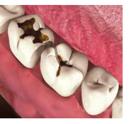 life-process-shows-badly-teeth-of-a-person-having-dental-caries.