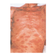 whydowefallillallergycausedbyrednessoftheskin