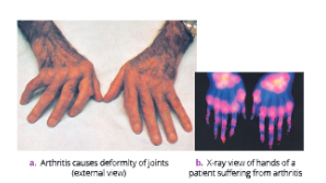 whydowefallillarthritisisadegenerativedisease