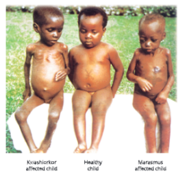 whydowefallillkwashiorkorandmarasmusaredeficiencydiseases